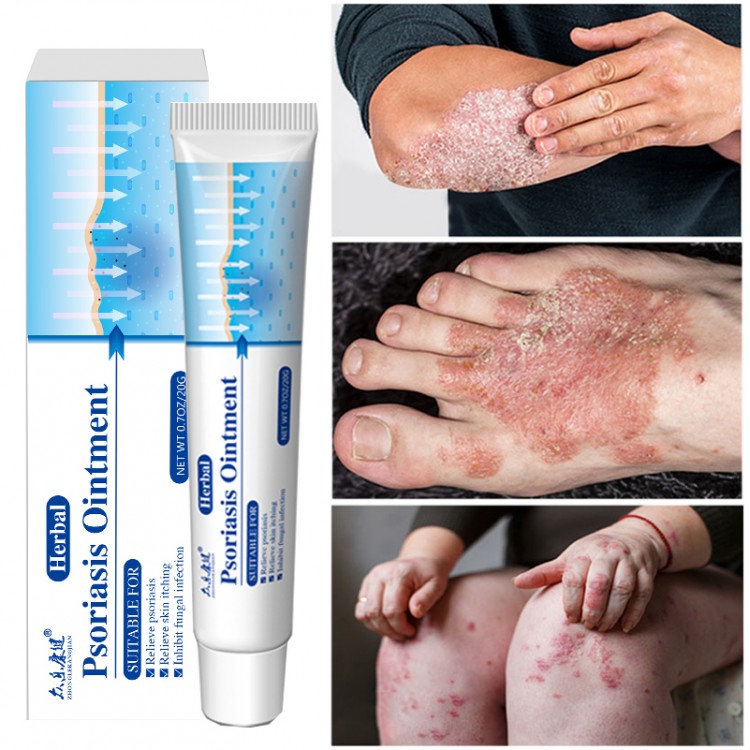 Antibacterial Cream Psoriasis Ointment Herbal Treatment Fungus Eczema Anti-itch Relief Rash Urticaria Desquamation Body Care