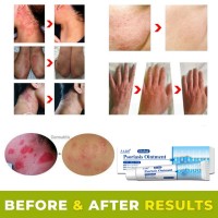 Antibacterial Cream Psoriasis Ointment Herbal Treatment Fungus Eczema Anti-itch Relief Rash Urticaria Desquamation Body Care