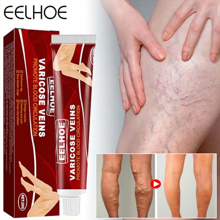 Varicose Veins Treatment Cream Vasculitis Phlebitis Spider Pain Relief Ointment Medical Herbal Plaster Beauty Body Health Care