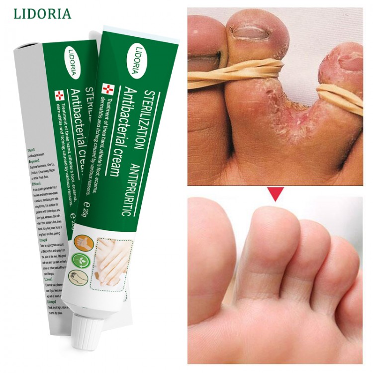 Foot Anti Bacterial Treatment Cream Herbal Remove Itching Soothe Eczema Dermatitis Ointment Anti-Fungal Nail Infection Feet Care