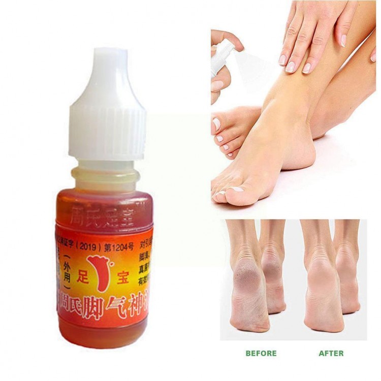 15ml Foot Odor Treatment Oil Anti Bacterial Anti-itch Sweat Medical Chinese Cure Beriberi Cream Foot Itching Ointment Care V5E8