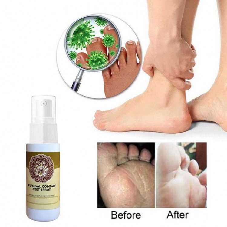 Herbal Fungal Combat Feet Spray Sterilize Spray Foot Cream Anti-fungal Infection Toe Treatment Onychomycosis Bacterial Foot Care